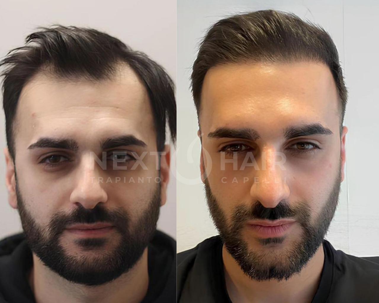 8 mesi dall'intervento. Tecnica DHI - 3800 UF