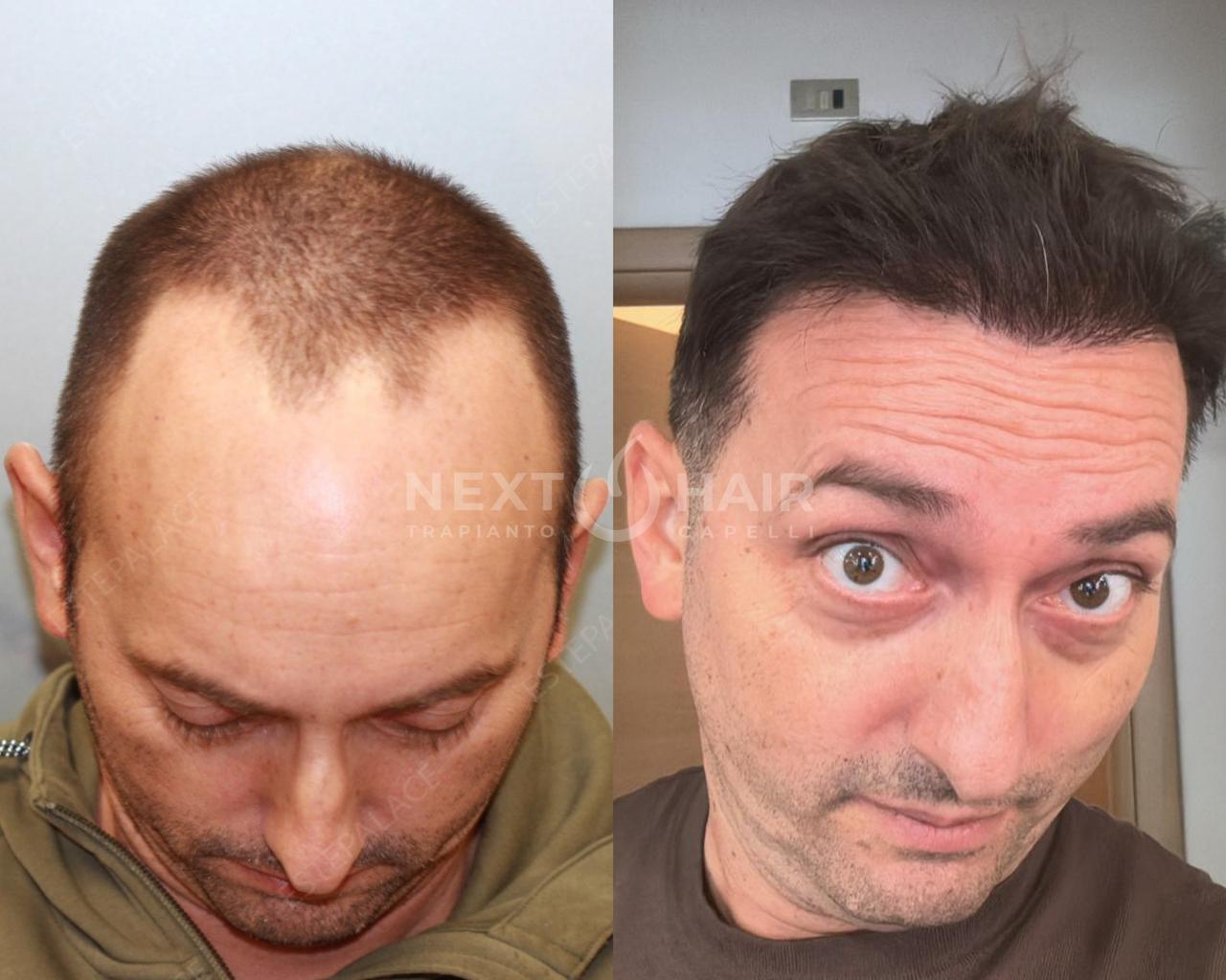 12 mesi dall'intervento. Tecnica FUE Zaffiro - 4600 UF