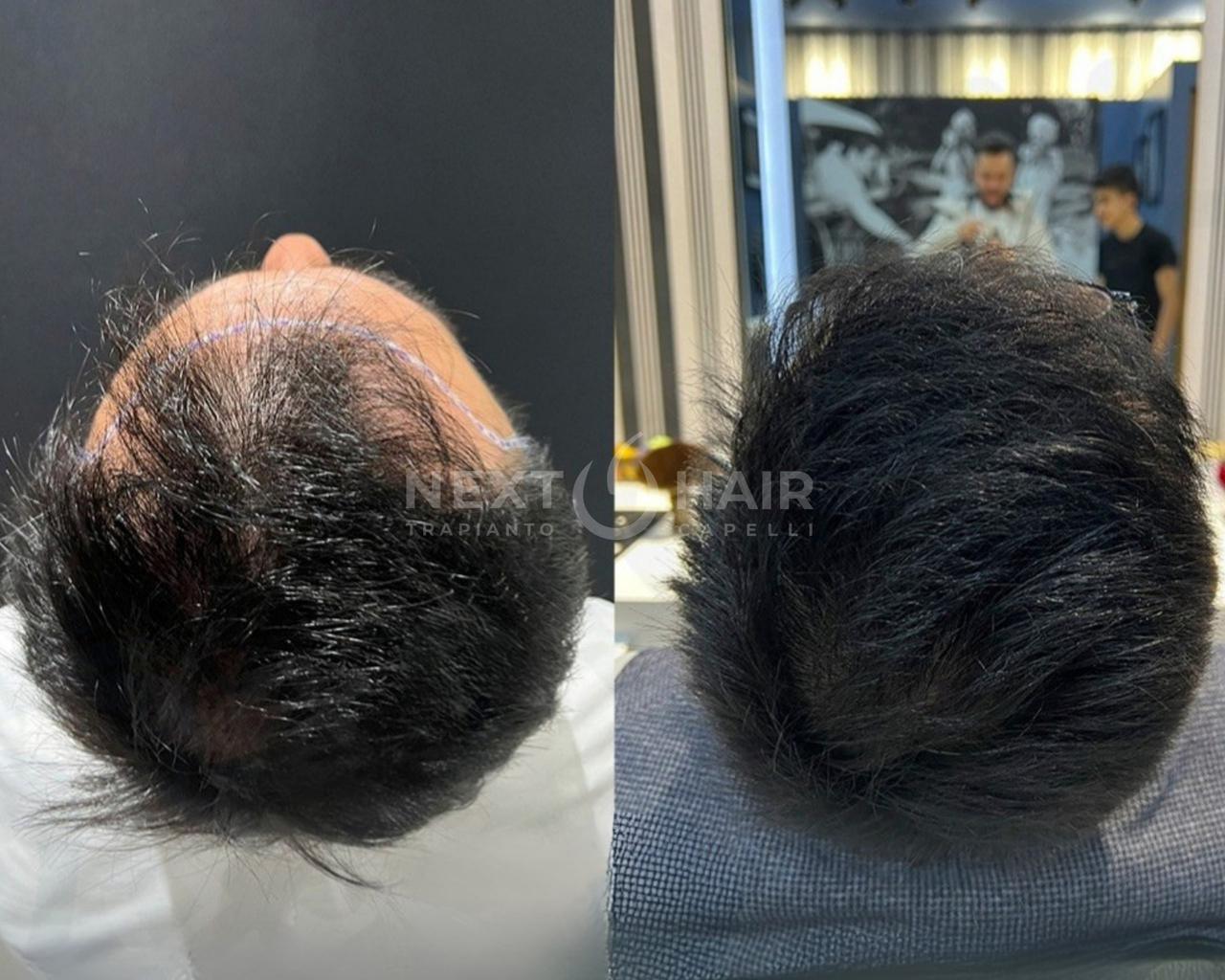 7 mesi dall'intervento. Tecnica DHI - 3850 UF