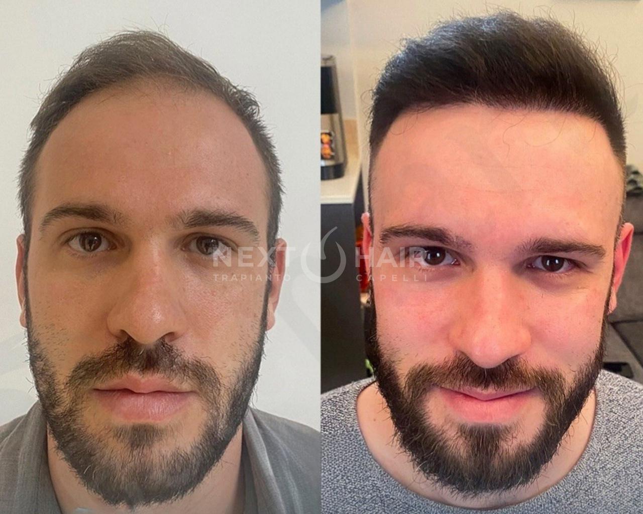 8 mesi dall'intervento. Tecnica DHI - 3660 UF