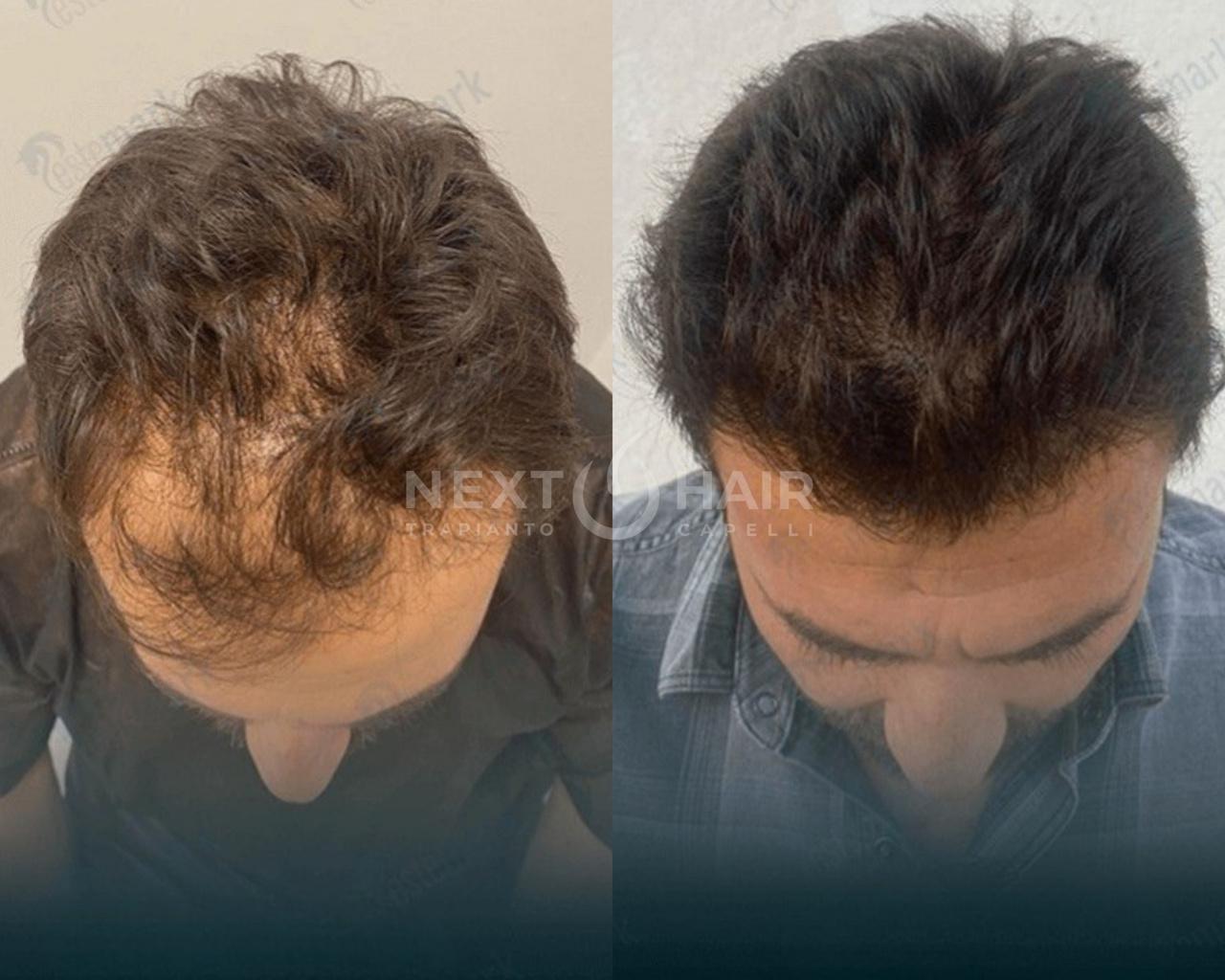 6 mesi dall'intervento. Tecnica DHI - 4100 UF