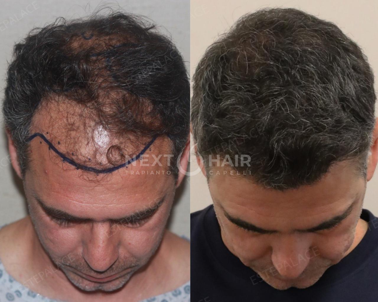 1 anno dall'intervento. Tecnica FUE Zaffiro - 4500 UF