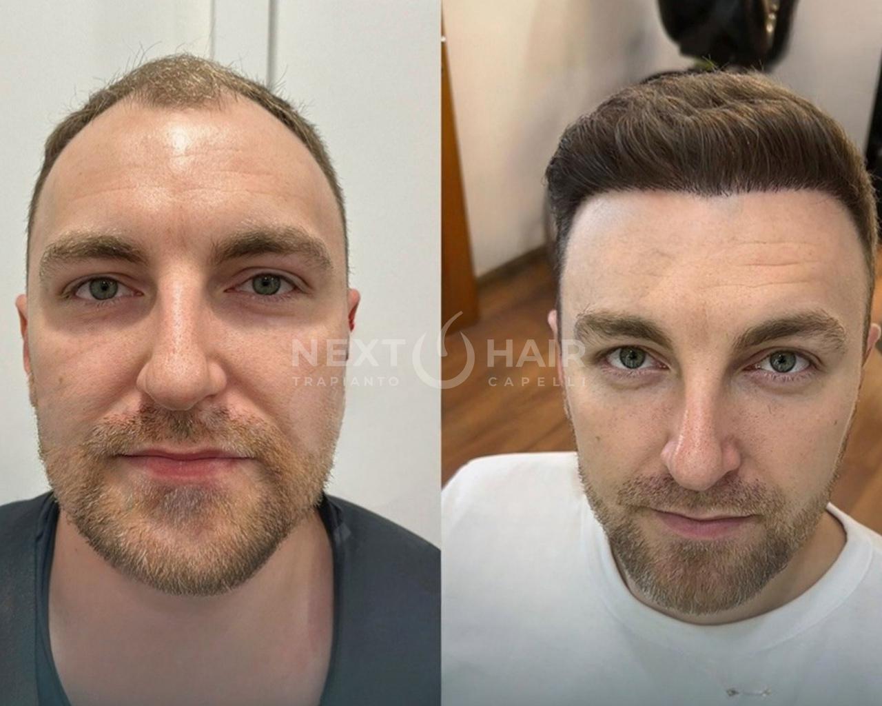 6 mesi. Tecnica DHI ad alta densità. Doppia sessione con 2 giorni consecutivi di operazione - 6115 UF