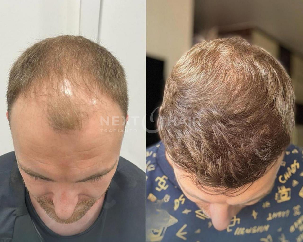 10 mesi. Tecnica DHI alta densità. Doppia sessione con 2 giorni consecutivi di operazione - 6115 UF