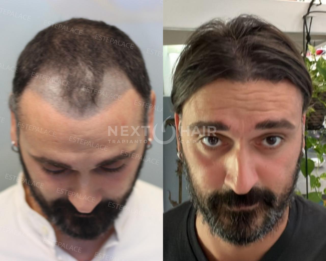 2 anni. Tecnica FUE Zaffiro - 4800 UF