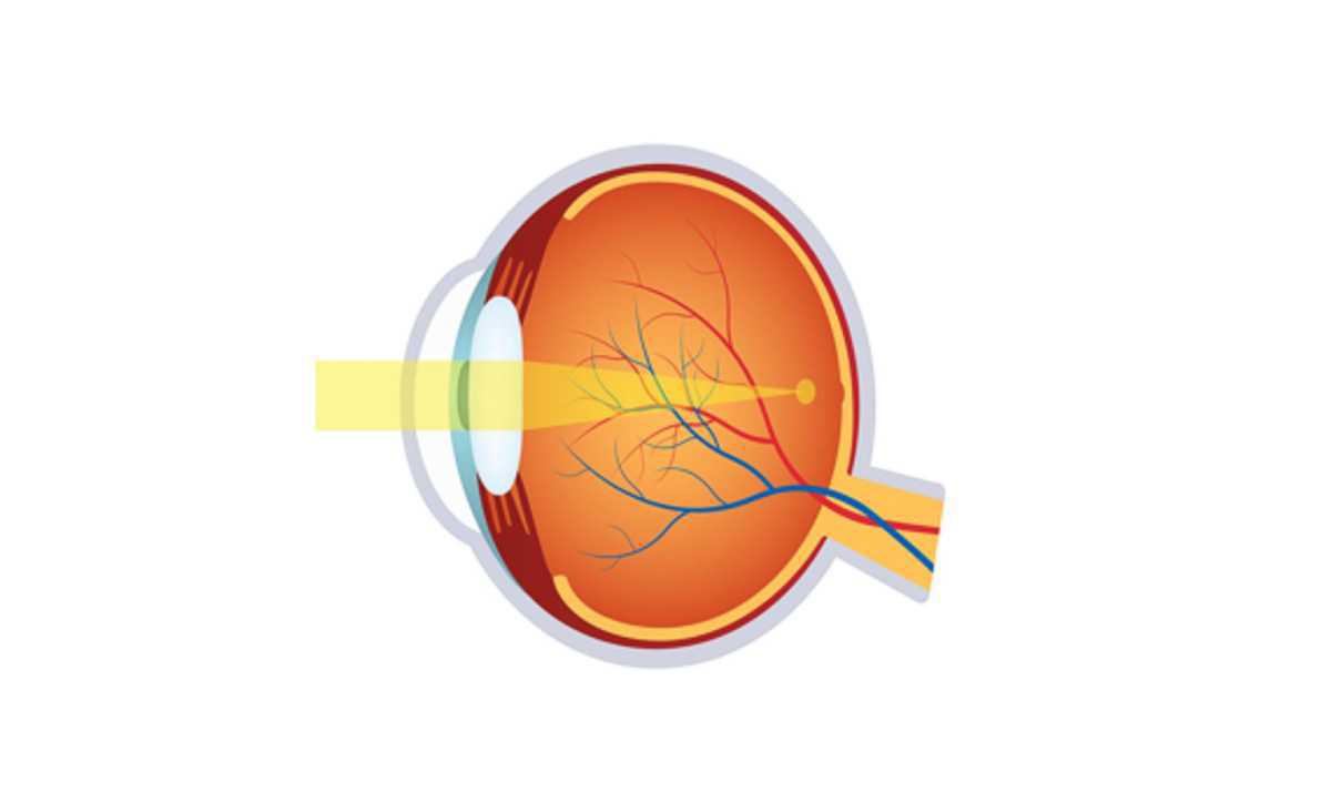 Miopía: una preocupación mundial Miopía: una preocupación mundial