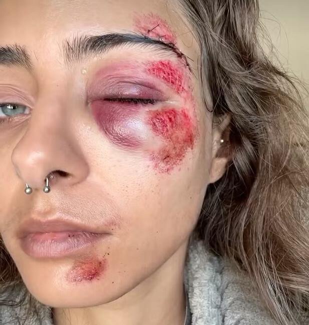 Mulher sofre grave acidente em buraco em Niterói e revela descaso da prefeitura Mulher sofre grave acidente em buraco em Niterói e revela descaso da prefeitura