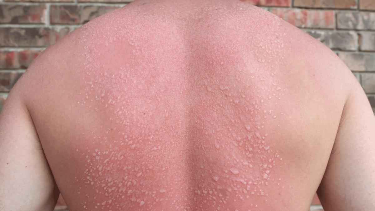 Quemaduras solares Quemaduras solares