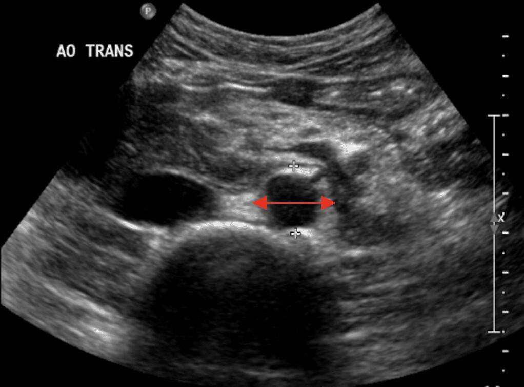 Aorte et Veine Cave Inférieure