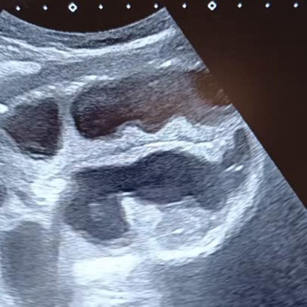 Occlusion Intestinale