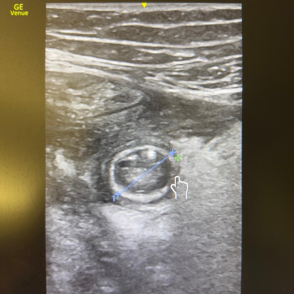 Appendicite Appendicite