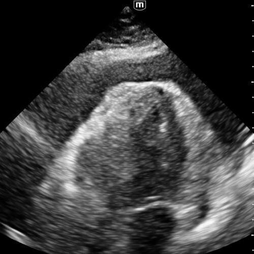 Épanchement péricardique et tamponnade