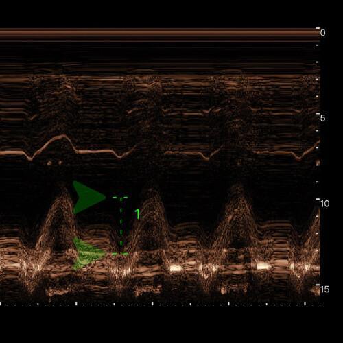 Dilatation et surcharge du VD