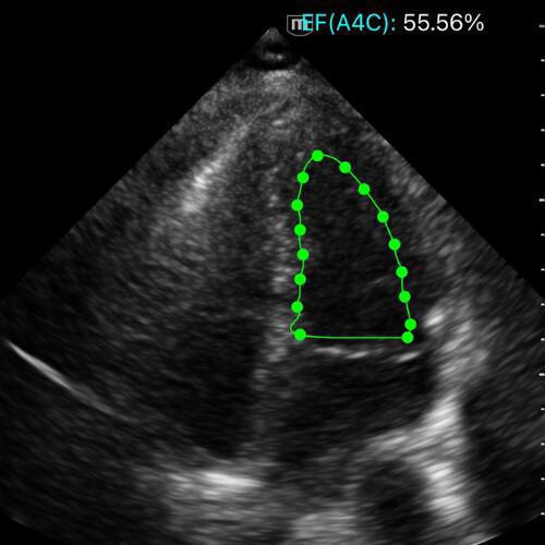 Fonction Systolique du VG