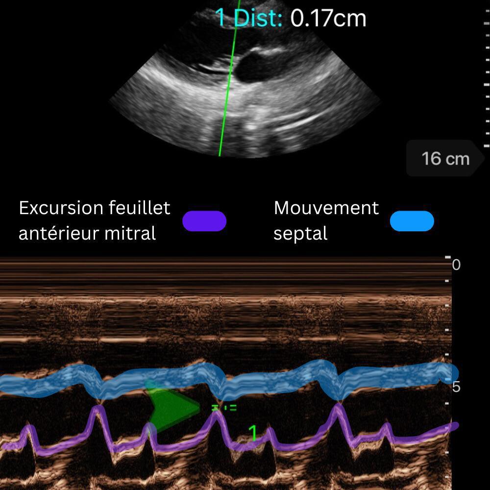 Fonction Systolique du VG