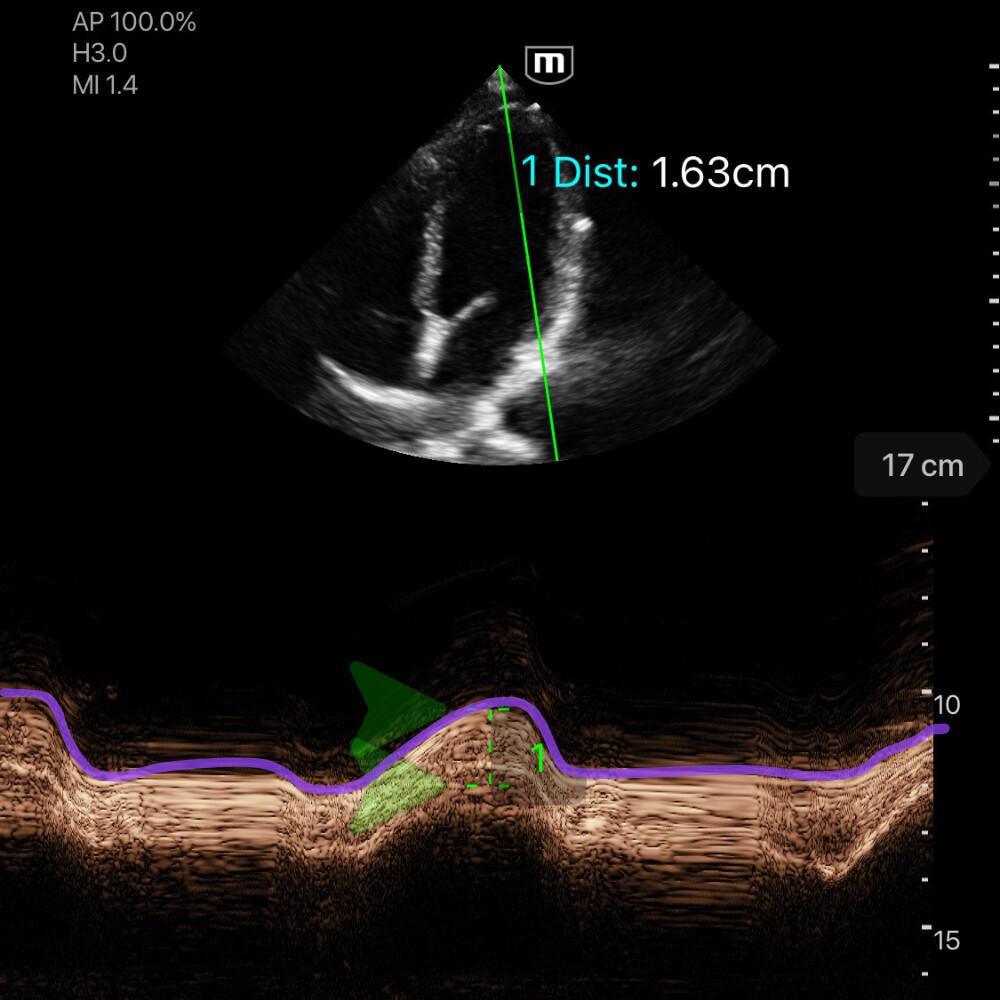 Fonction Systolique du VG Fonction Systolique du VG