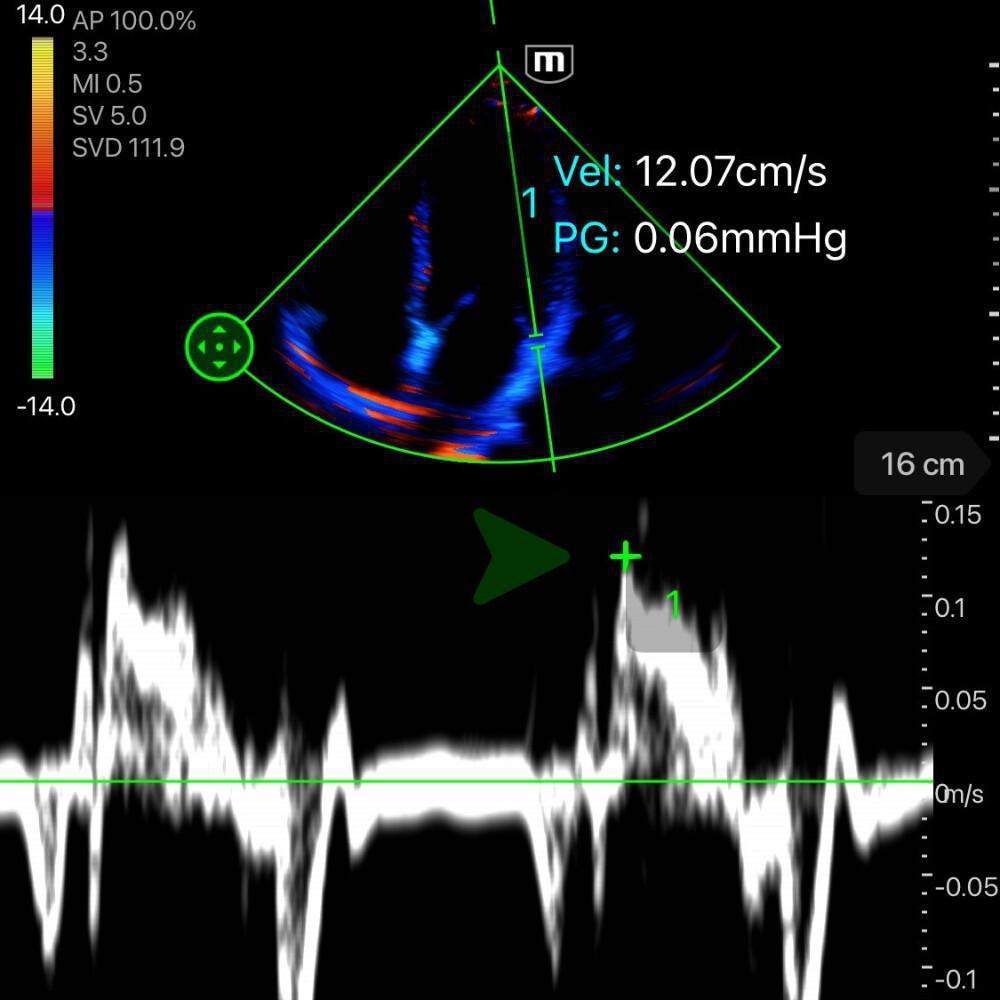 Fonction Systolique du VG
