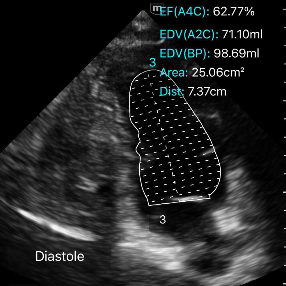 Fonction Systolique du VG Fonction Systolique du VG