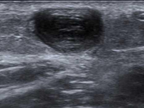 Thrombose veineuse profonde Thrombose veineuse profonde