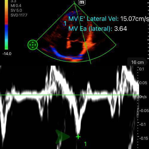 Fonction diastolique et précharge Fonction diastolique et précharge