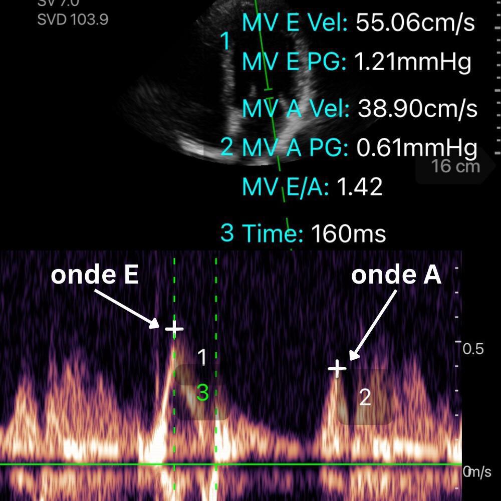 Fonction diastolique et précharge Fonction diastolique et précharge