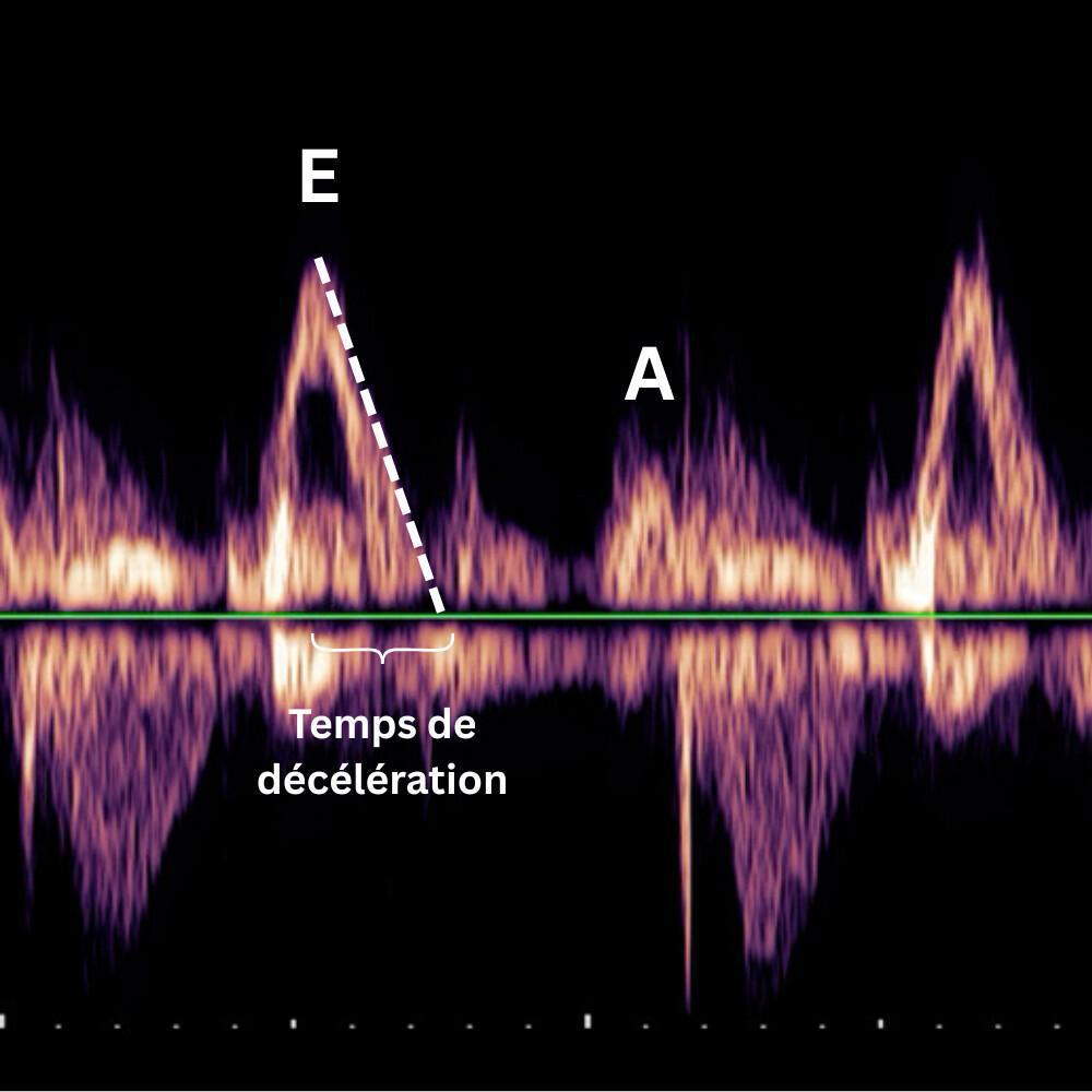 Fonction diastolique et précharge