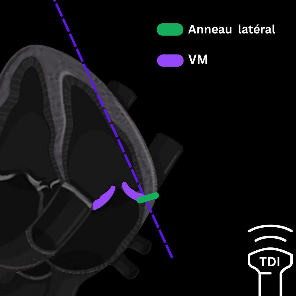 Fonction diastolique et précharge Fonction diastolique et précharge