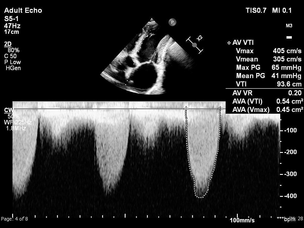 Valvulopathies – Rétrécissement aortique