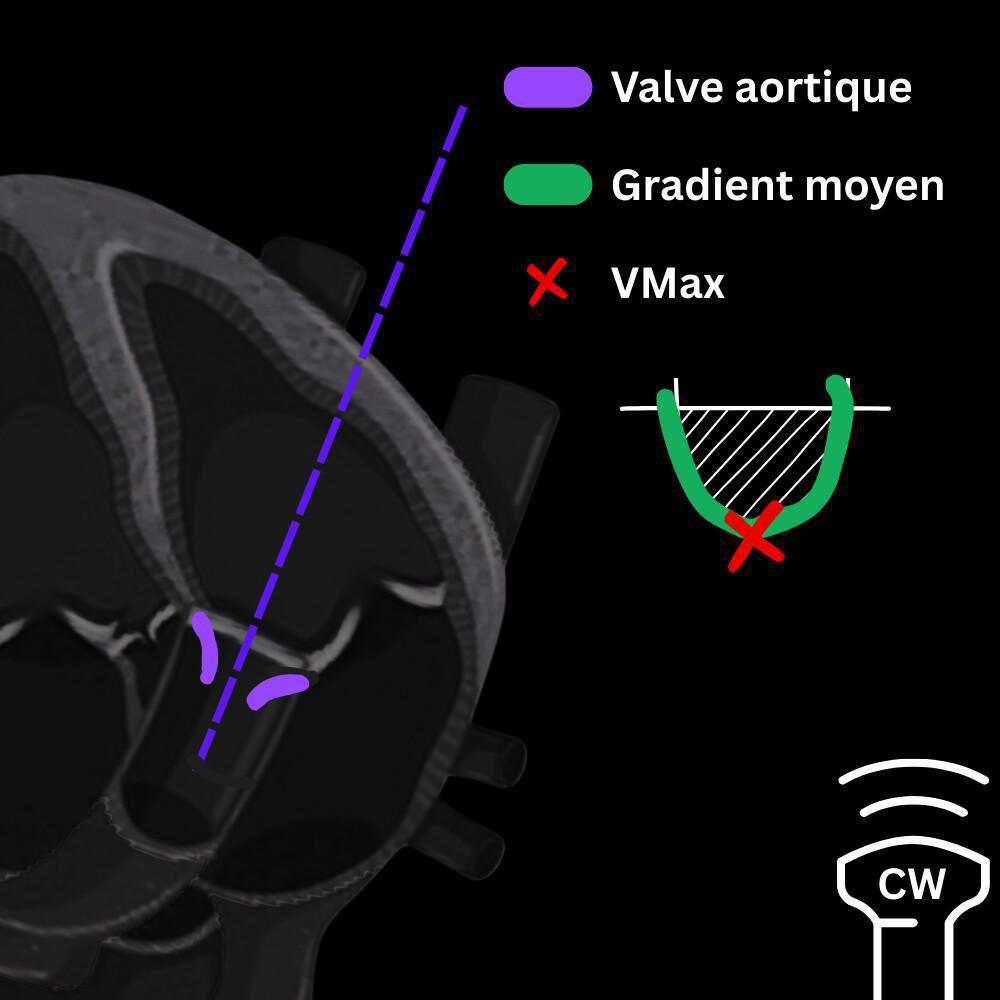 Valvulopathies – Rétrécissement aortique Valvulopathies – Rétrécissement aortique