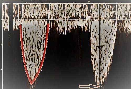 Valvulopathies – Rétrécissement aortique