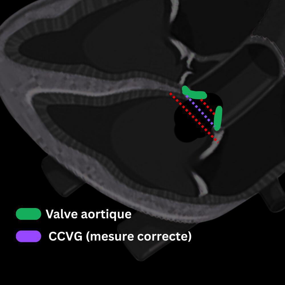 Valvulopathies – Rétrécissement aortique Valvulopathies – Rétrécissement aortique