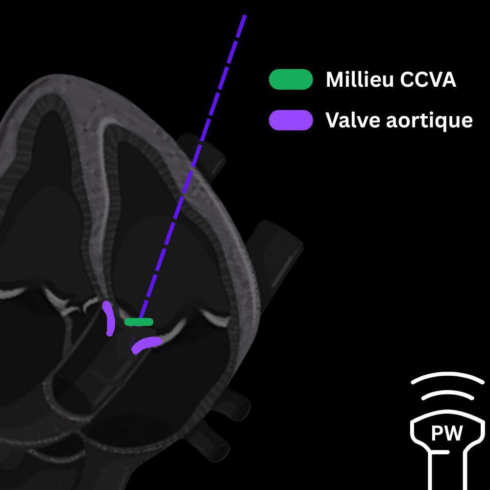 Valvulopathies – Rétrécissement aortique Valvulopathies – Rétrécissement aortique