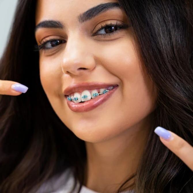 FAST BRACES