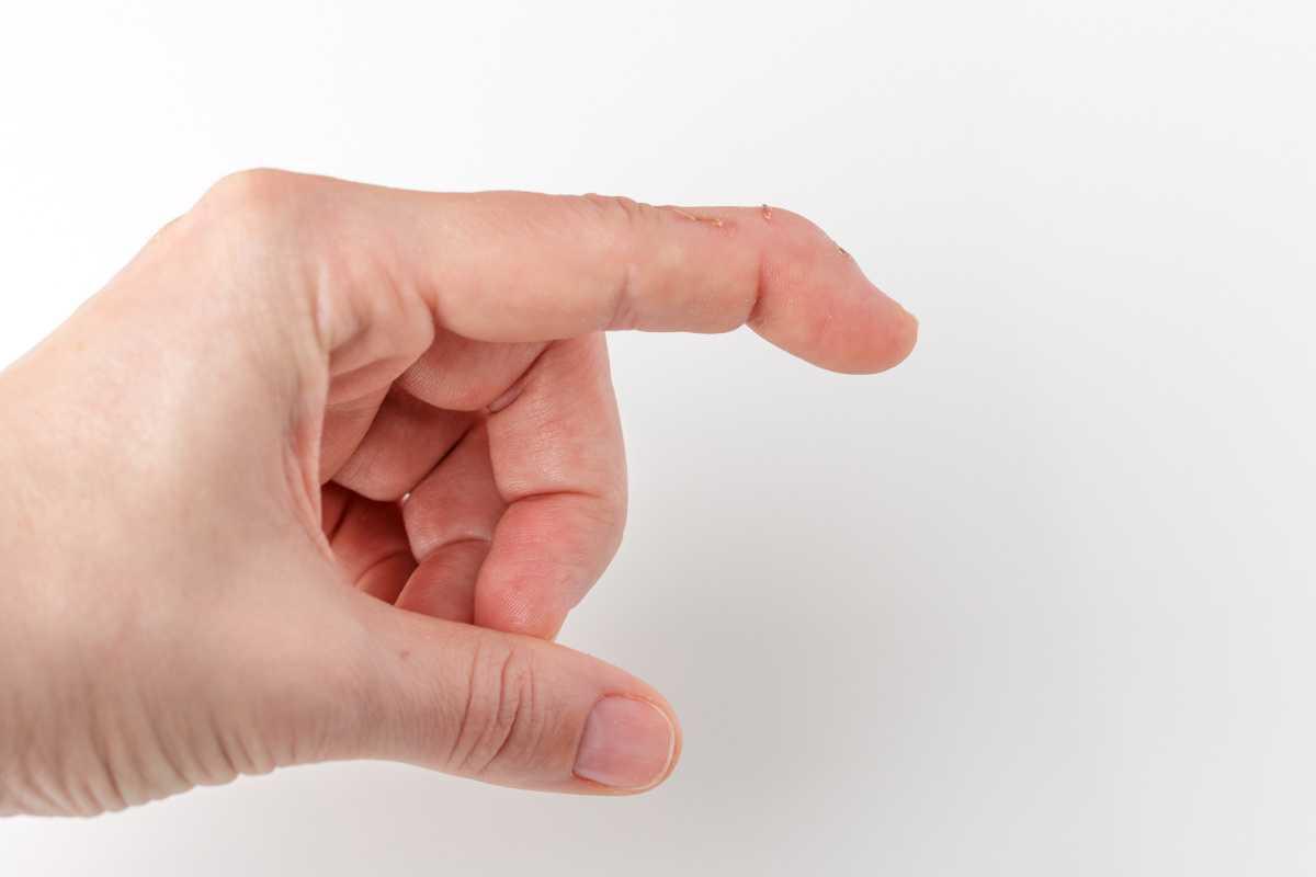 Quand commencer le traitement orthétique d'un maillet tendineux ? Quand commencer le traitement orthétique d'un maillet tendineux ?