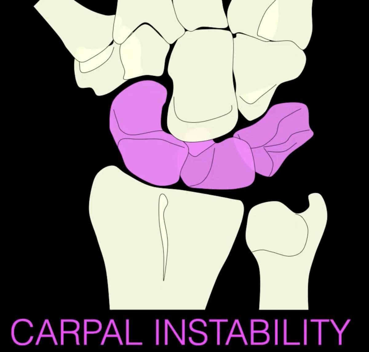 Carpal instability - non surgical treatment - Dr Hagert