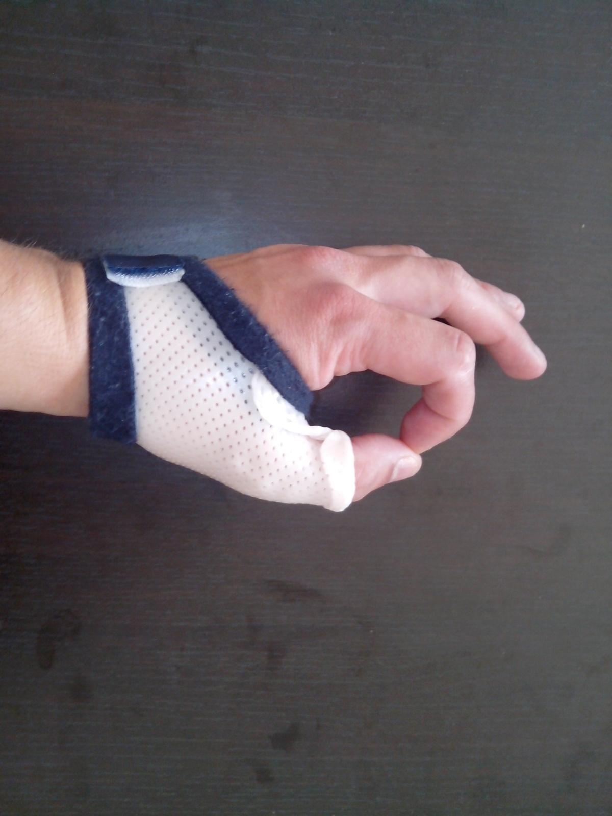 Orthèses de la main : raisonnement clinique et parcours de soins