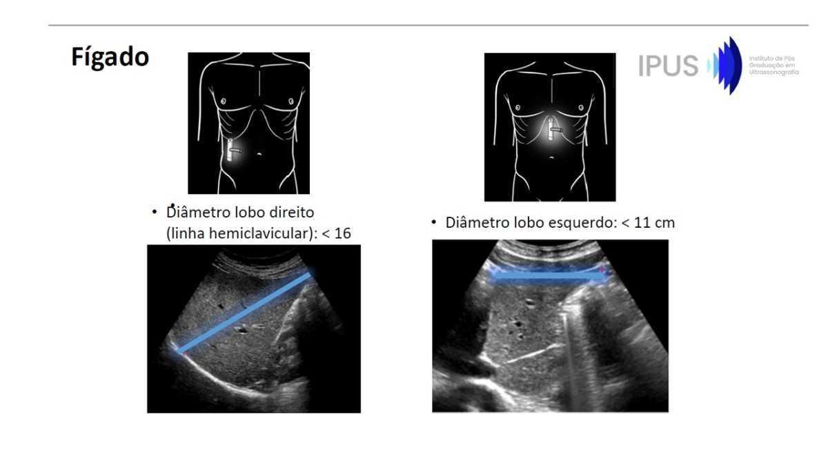 Tabelas em US Abdominal