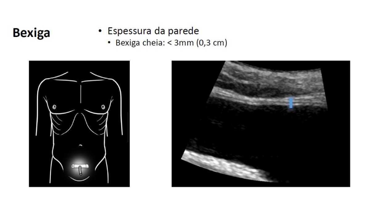 Tabelas em US Abdominal