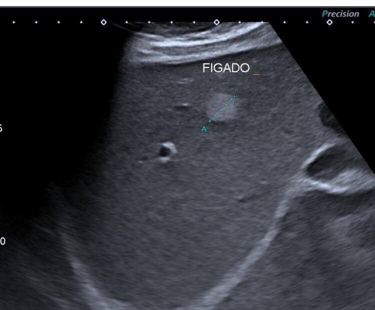 ULTRASSOM ABDOMINAL ULTRASSOM ABDOMINAL