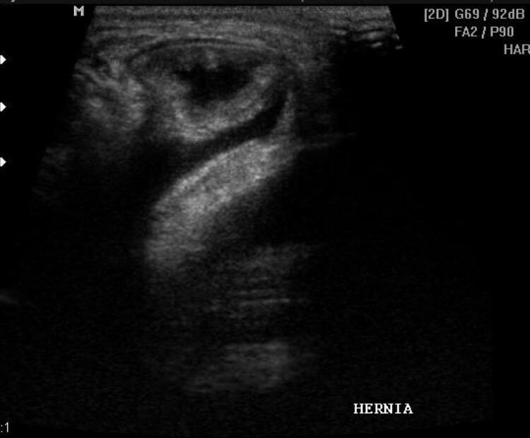 ULTRASSOM DA PAREDE ABDOMINAL E REGIÂO INGUINAL ULTRASSOM DA PAREDE ABDOMINAL E REGIÂO INGUINAL