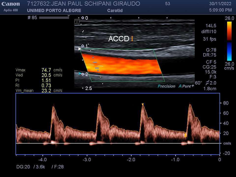ECODOPPLER DE CARÓTIDAS