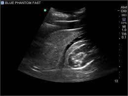 POCUS E FAST