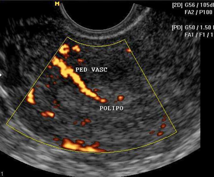 ULTRASSOM TRANSVAGINAL