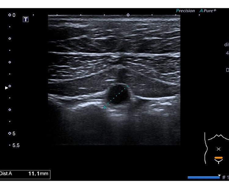 Biblioteca de imagens - Parede abdominal