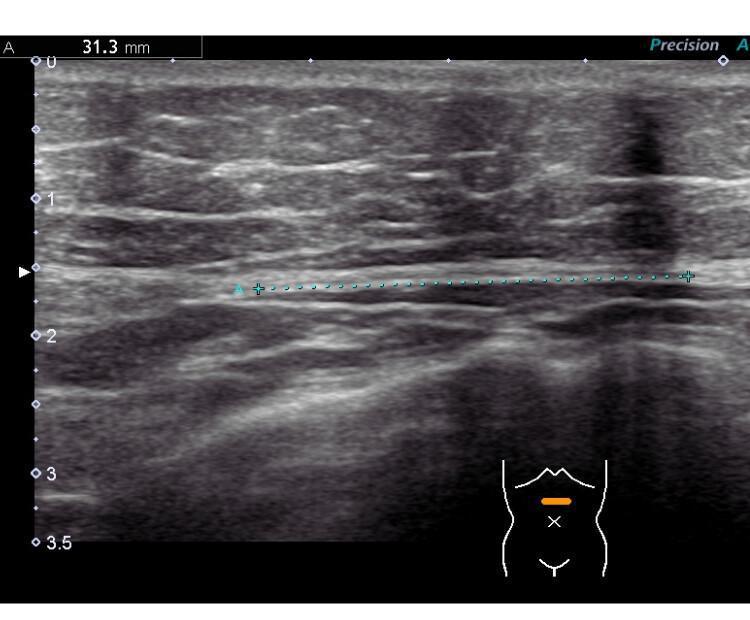 Biblioteca de imagens - Parede abdominal