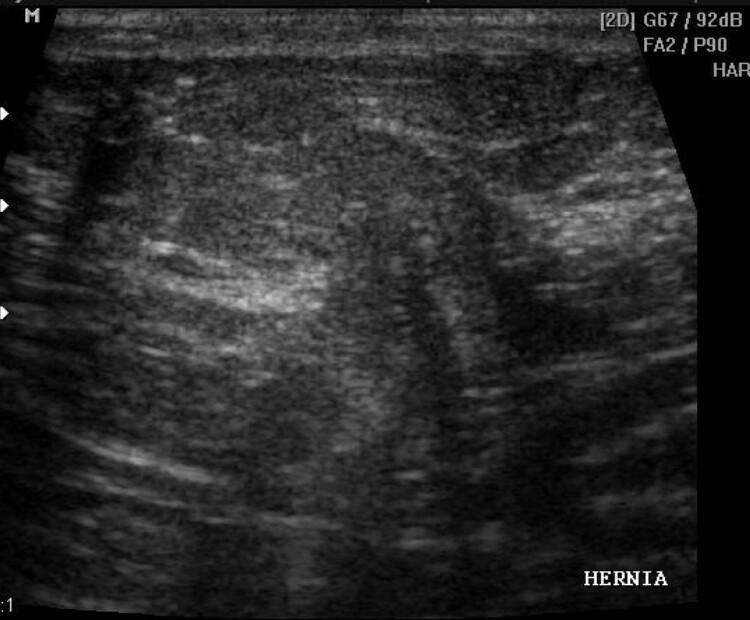 Biblioteca de imagens - Parede abdominal