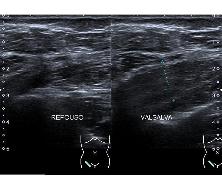 Biblioteca de imagens - Parede abdominal