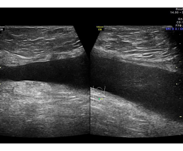 Biblioteca de imagens - Parede abdominal