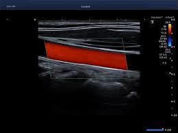 ECODOPPLER ARTERIAL 