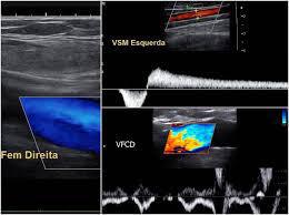 ECODOPPLER VENOSO ECODOPPLER VENOSO